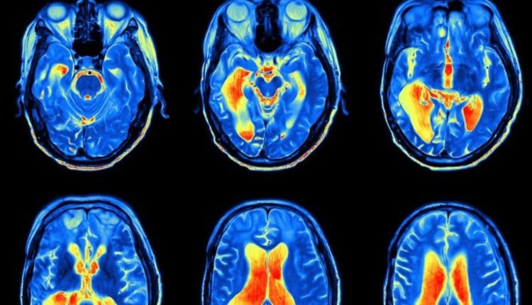 البروتينات و الزهايمر